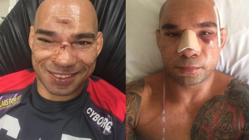 Soldat Universal. Luptatorul care s-a ales cu craniul fracturat in cusca de MMA a fost operat. Cum arata acum