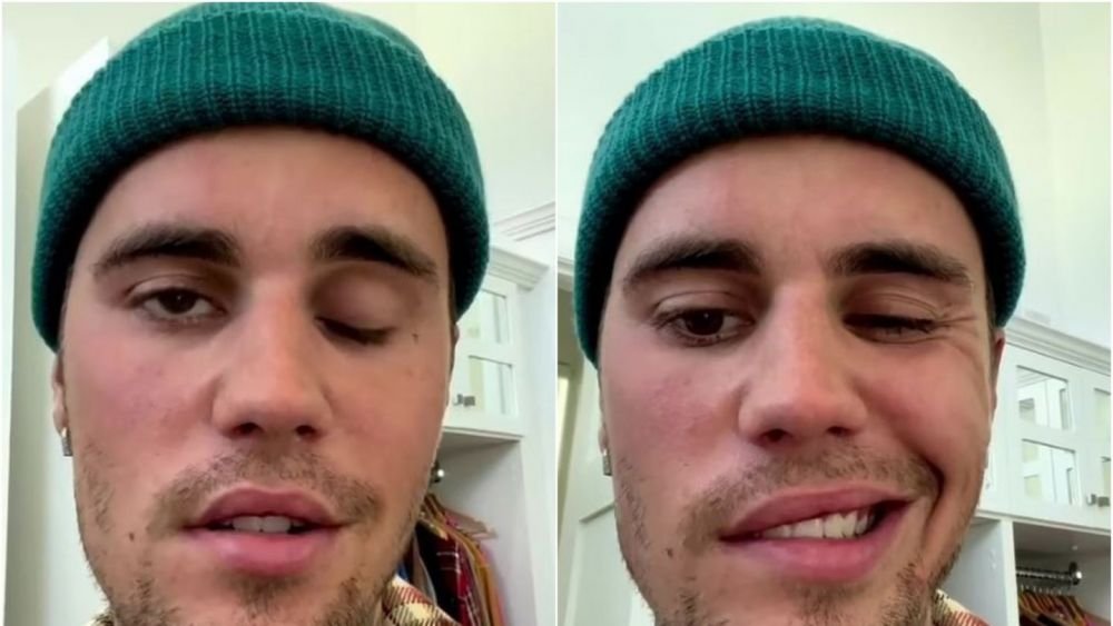 Cu fața încă paralizată, Justin Bieber își anulează din nou concertele: Sănătatea mea trebuie să fie o prioritate!"